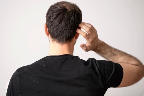 Erkekler İçin Saç Derisi Sağlığı