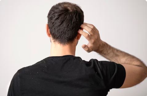 Erkeklerde Saç Kepeğini Önleme